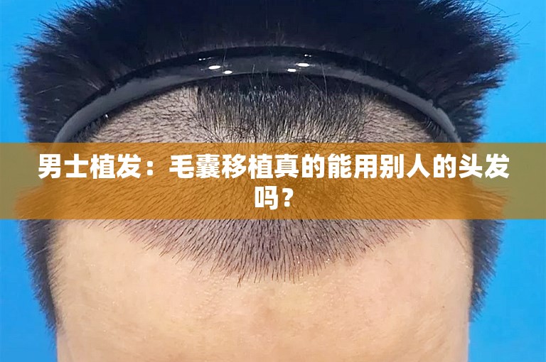 男士植发：毛囊移植真的能用别人的头发吗？