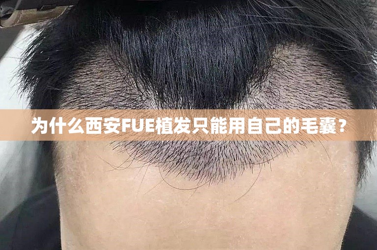 为什么西安FUE植发只能用自己的毛囊？