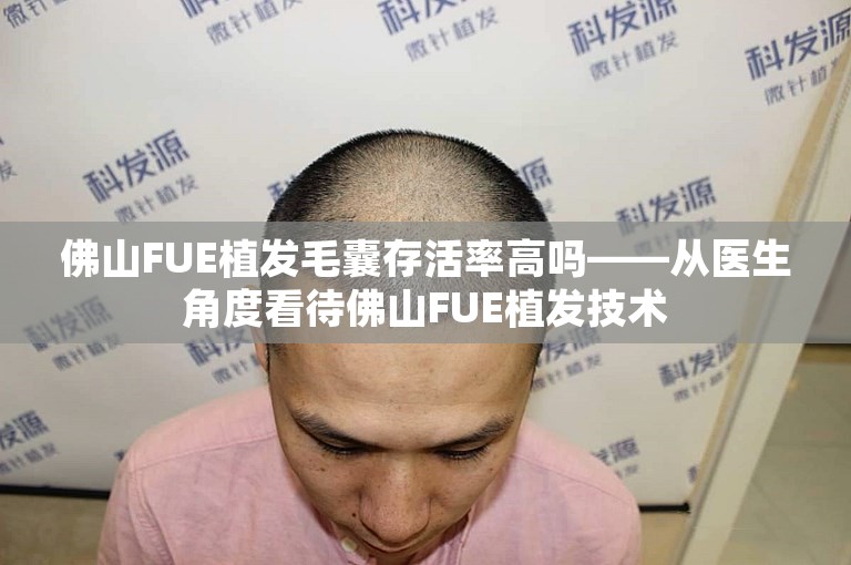 佛山FUE植发毛囊存活率高吗——从医生角度看待佛山FUE植发技术