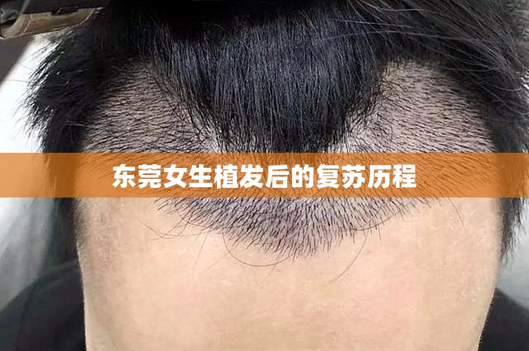 东莞女生植发后的复苏历程