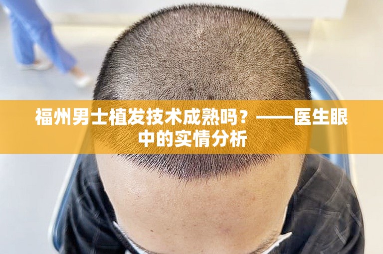 福州男士植发技术成熟吗？——医生眼中的实情分析