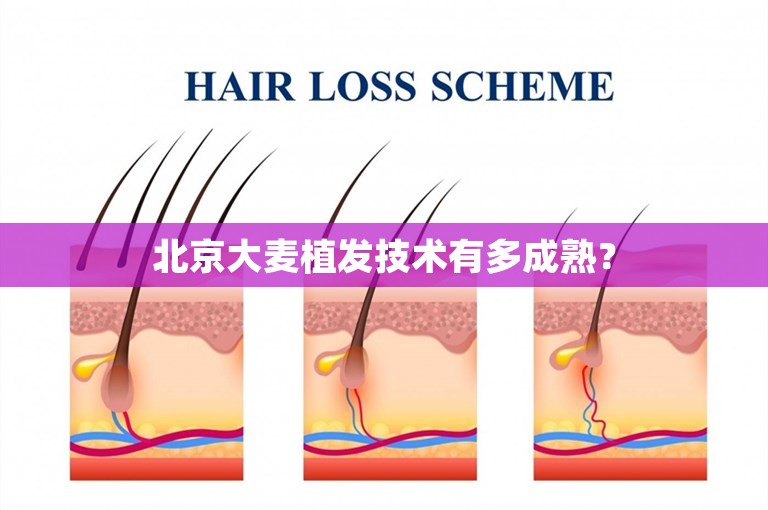 北京大麦植发技术有多成熟？