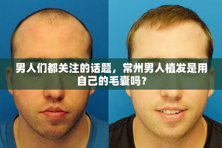 男人们都关注的话题，常州男人植发是用自己的毛囊吗？