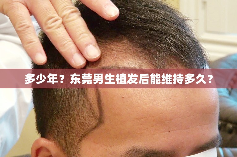 多少年？东莞男生植发后能维持多久？