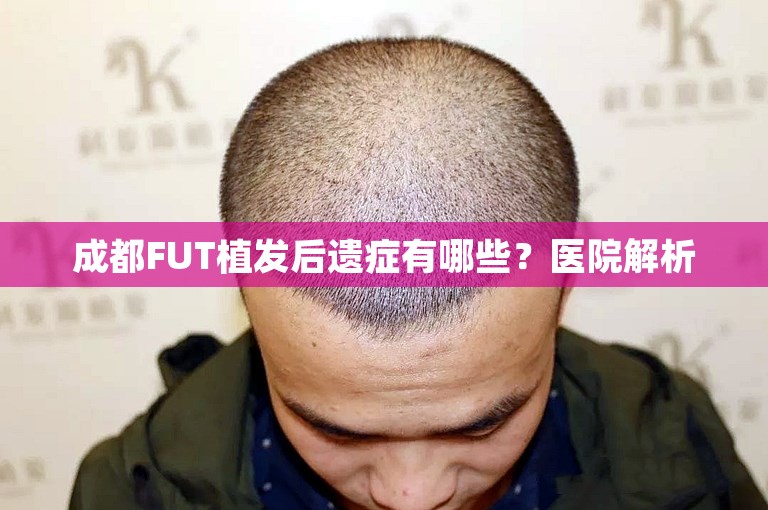 成都FUT植发后遗症有哪些？医院解析