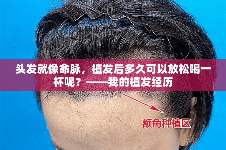 头发就像命脉，植发后多久可以放松喝一杯呢？——我的植发经历