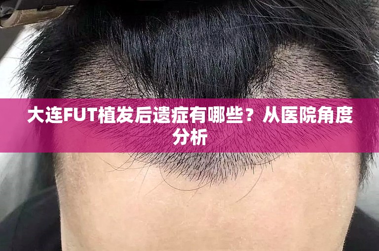 大连FUT植发后遗症有哪些？从医院角度分析