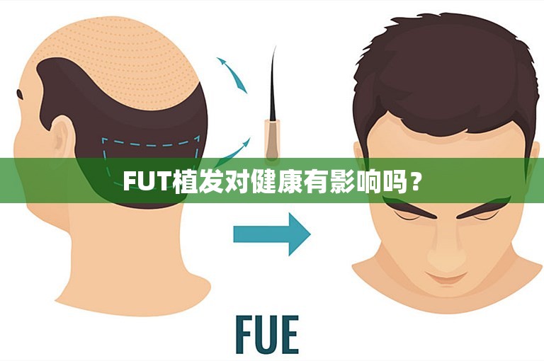 FUT植发对健康有影响吗？