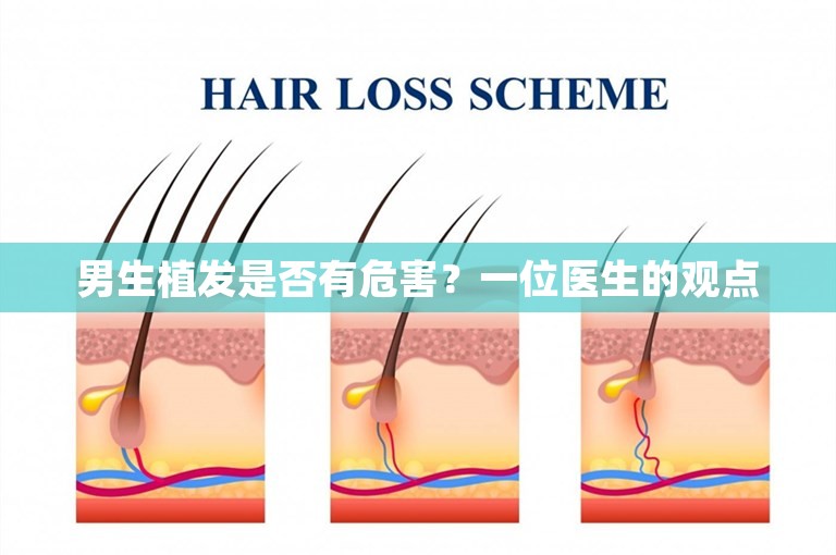 男生植发是否有危害？一位医生的观点