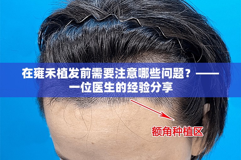 在雍禾植发前需要注意哪些问题？——一位医生的经验分享