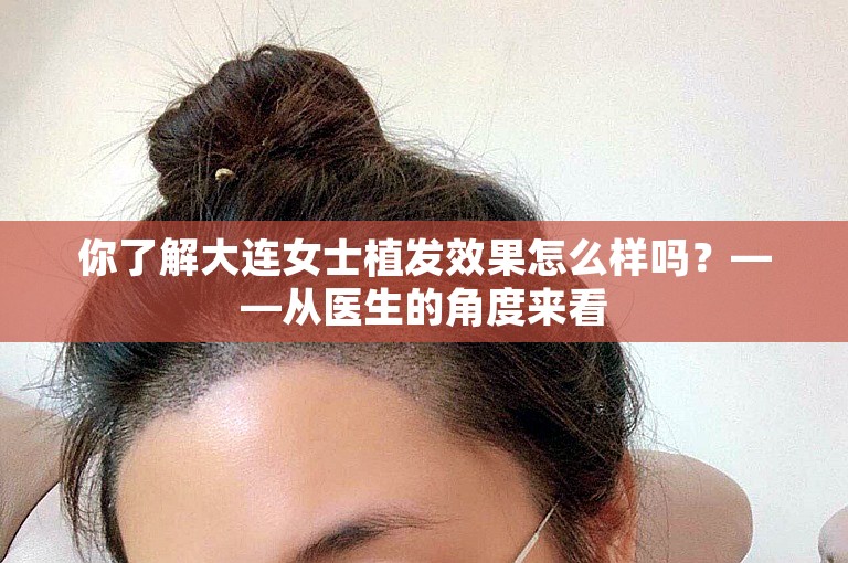 你了解大连女士植发效果怎么样吗？——从医生的角度来看