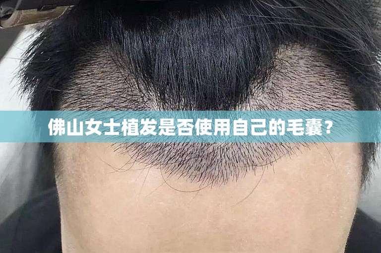 佛山女士植发是否使用自己的毛囊？