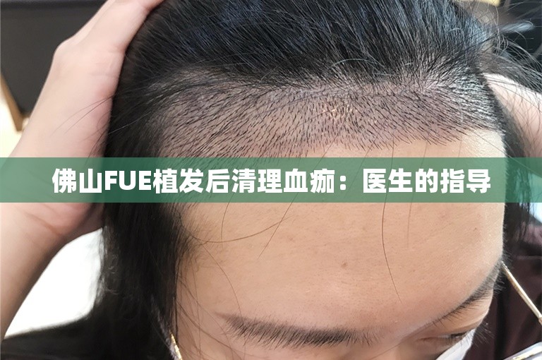 佛山FUE植发后清理血痂：医生的指导