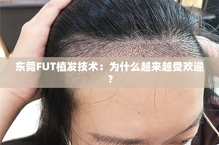 东莞FUT植发技术：为什么越来越受欢迎？