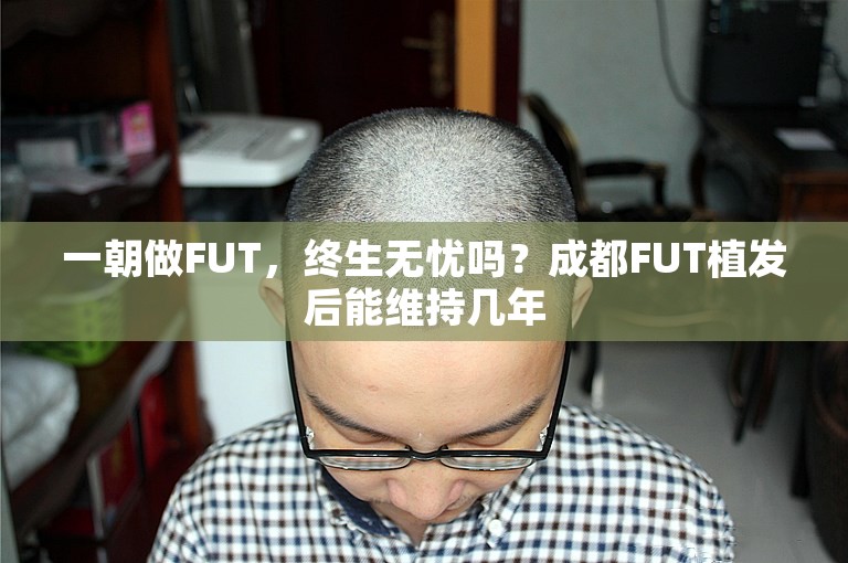 一朝做FUT，终生无忧吗？成都FUT植发后能维持几年