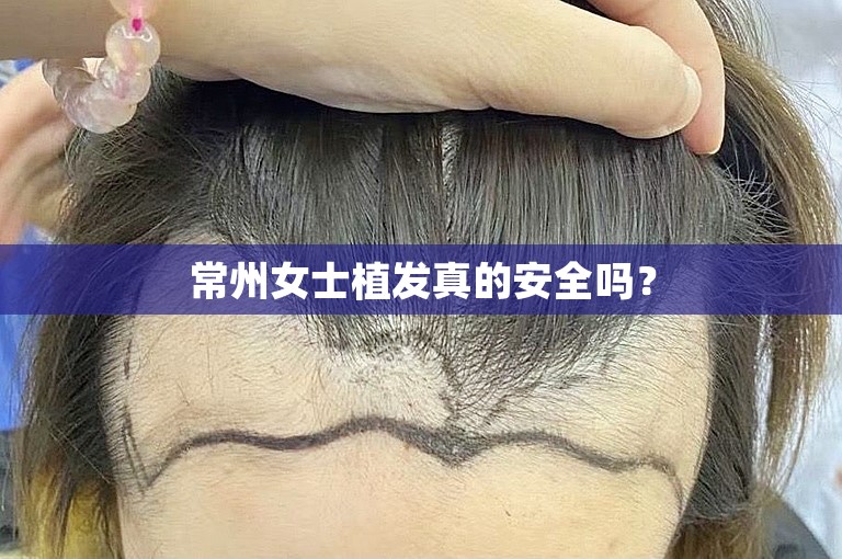 常州女士植发真的安全吗？