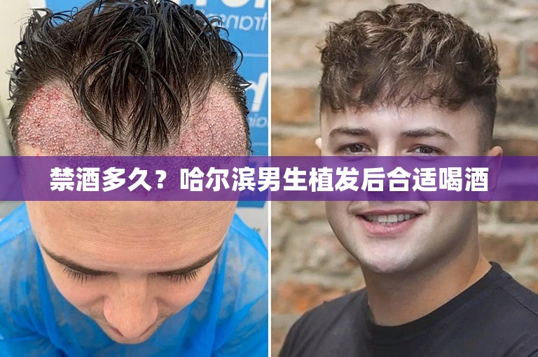 禁酒多久？哈尔滨男生植发后合适喝酒