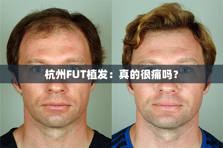 杭州FUT植发：真的很痛吗？