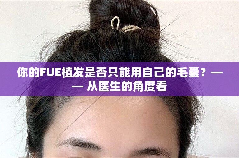 你的FUE植发是否只能用自己的毛囊？—— 从医生的角度看