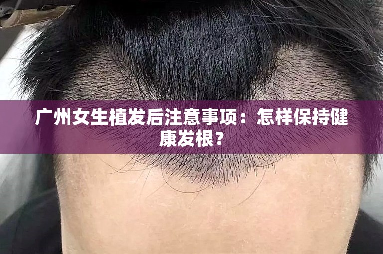 广州女生植发后注意事项：怎样保持健康发根？