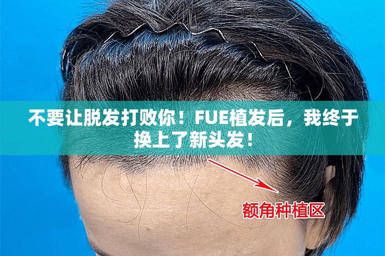 不要让脱发打败你！FUE植发后，我终于换上了新头发！