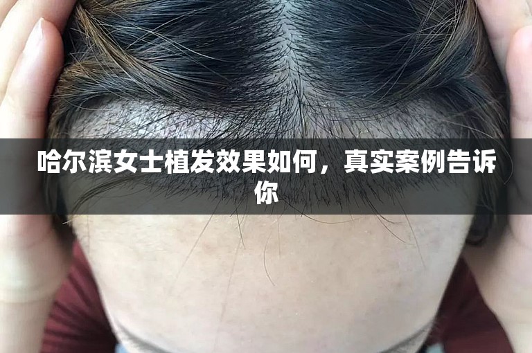 哈尔滨女士植发效果如何，真实案例告诉你