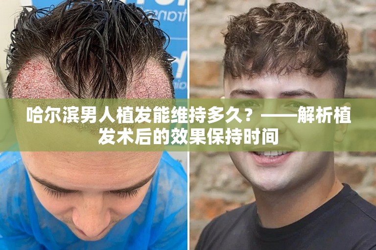 哈尔滨男人植发能维持多久？——解析植发术后的效果保持时间