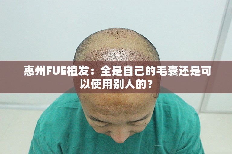  惠州FUE植发：全是自己的毛囊还是可以使用别人的？