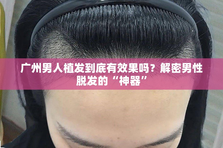 广州男人植发到底有效果吗？解密男性脱发的“神器”