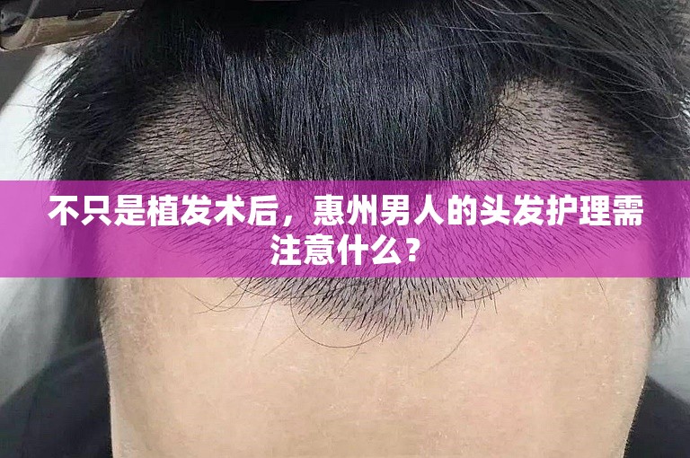 不只是植发术后，惠州男人的头发护理需注意什么？