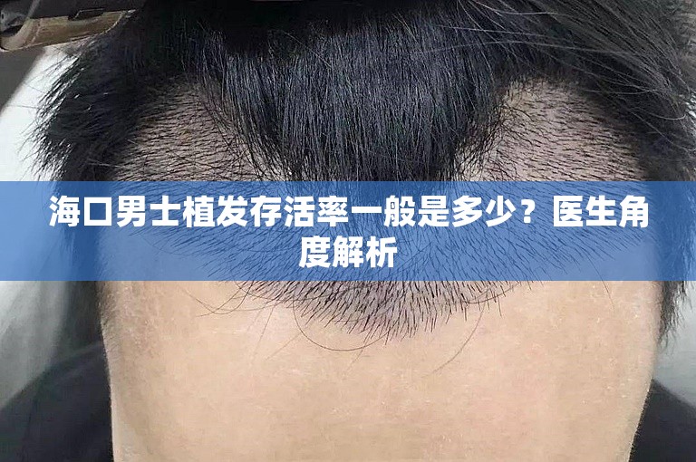 海口男士植发存活率一般是多少？医生角度解析