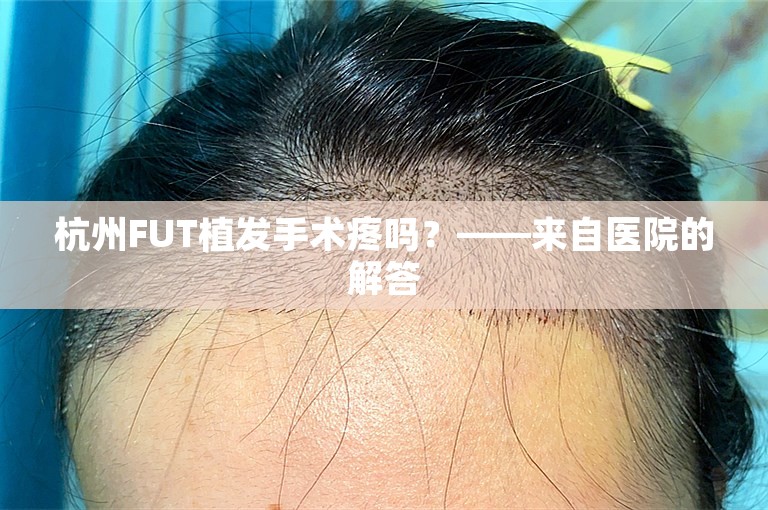 杭州FUT植发手术疼吗？——来自医院的解答