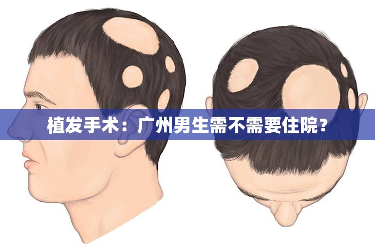 植发手术：广州男生需不需要住院？