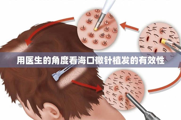 用医生的角度看海口微针植发的有效性