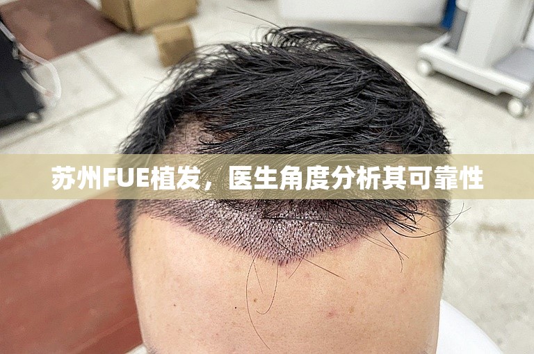 苏州FUE植发，医生角度分析其可靠性