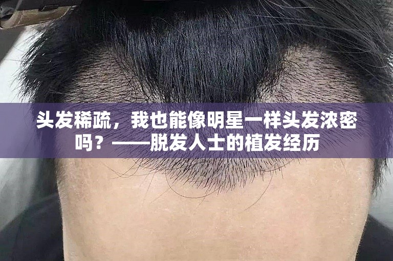 头发稀疏，我也能像明星一样头发浓密吗？——脱发人士的植发经历