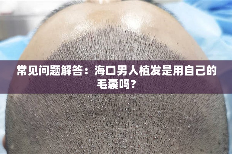 常见问题解答：海口男人植发是用自己的毛囊吗？