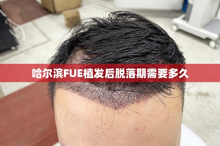 哈尔滨FUE植发后脱落期需要多久