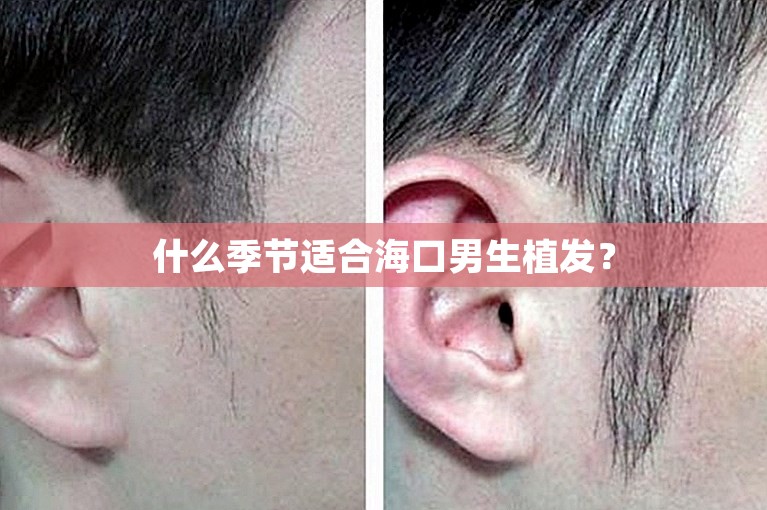 什么季节适合海口男生植发？