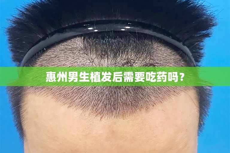 惠州男生植发后需要吃药吗？