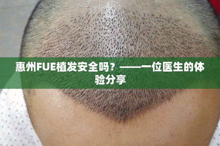 惠州FUE植发安全吗？——一位医生的体验分享