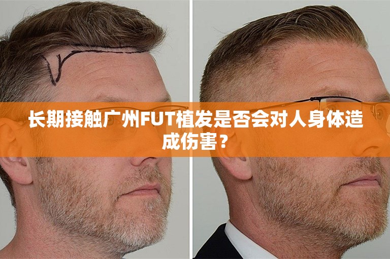 长期接触广州FUT植发是否会对人身体造成伤害？