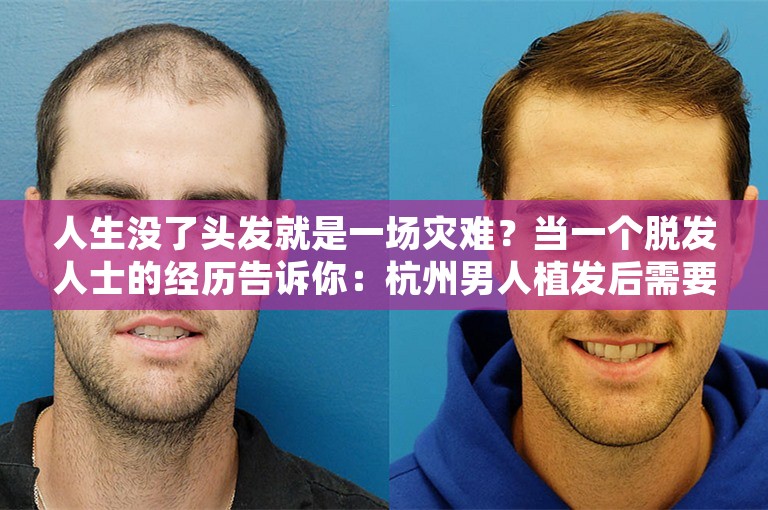 人生没了头发就是一场灾难？当一个脱发人士的经历告诉你：杭州男人植发后需要吃药吗