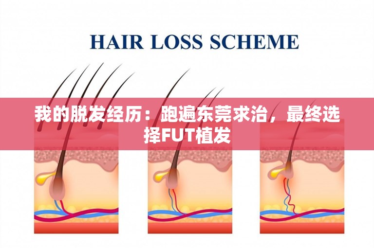 我的脱发经历：跑遍东莞求治，最终选择FUT植发