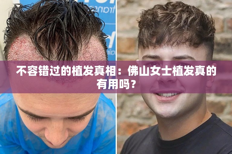 不容错过的植发真相：佛山女士植发真的有用吗？