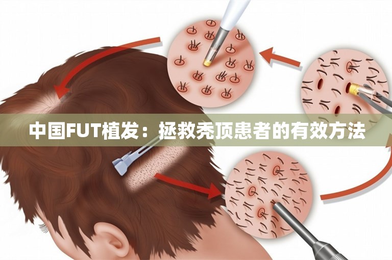 中国FUT植发：拯救秃顶患者的有效方法