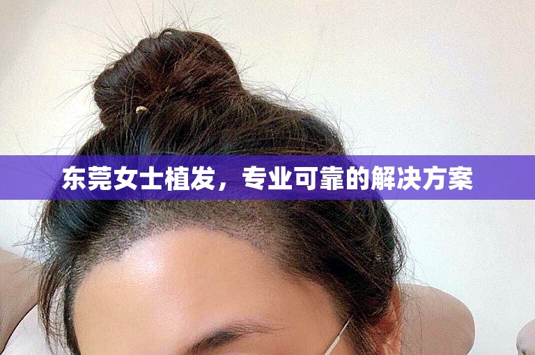 东莞女士植发，专业可靠的解决方案