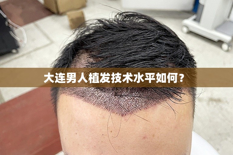  大连男人植发技术水平如何？ 