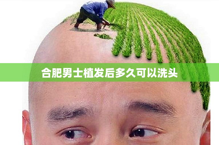 合肥男士植发后多久可以洗头