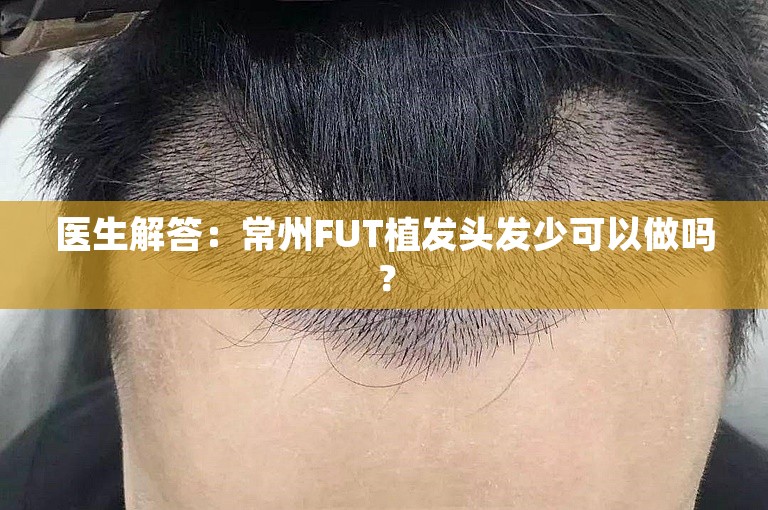 医生解答：常州FUT植发头发少可以做吗？